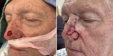 Mohs Reconstruction Before and After Photos in Voorhees Township, NJ, Patient 4198