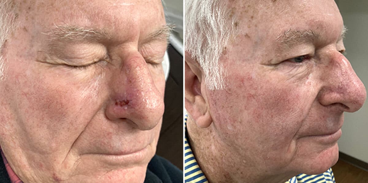 Mohs Reconstruction Before and After Photos in Voorhees Township, NJ, Patient 4199