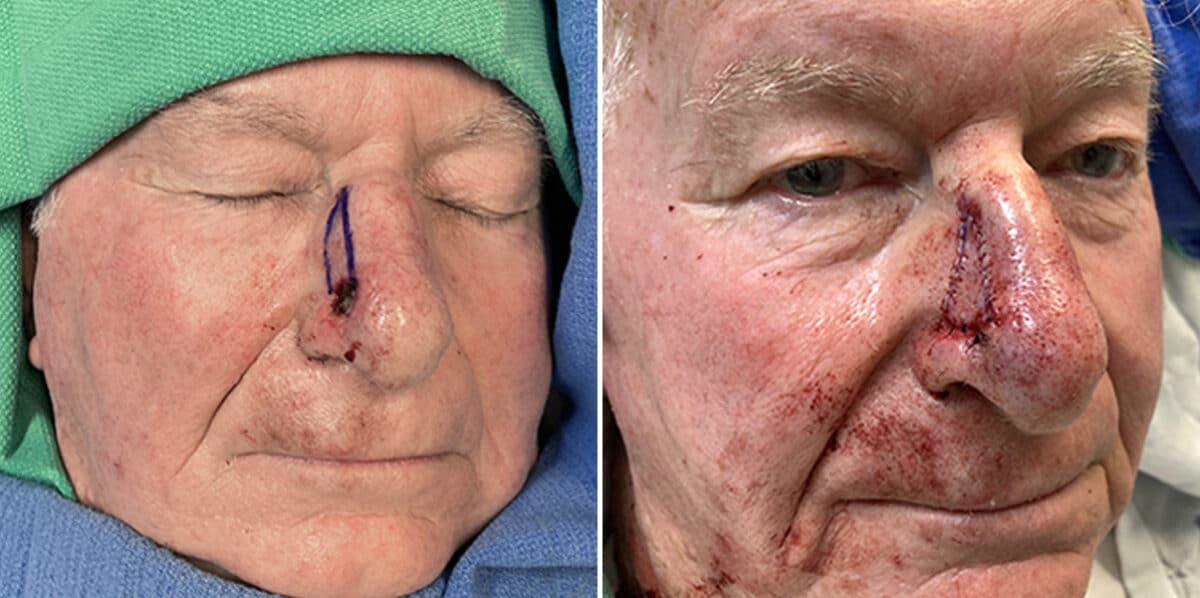 Mohs Reconstruction Before and After Photos in Voorhees Township, NJ, Patient 4199