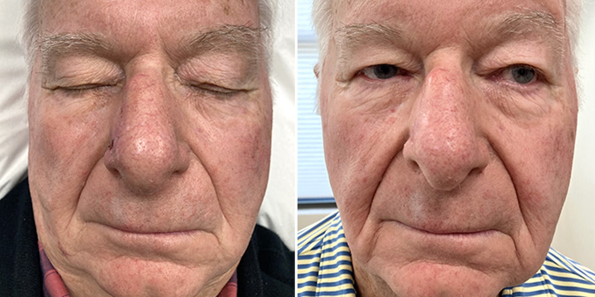 Mohs Reconstruction Before and After Photos in Voorhees Township, NJ, Patient 4199