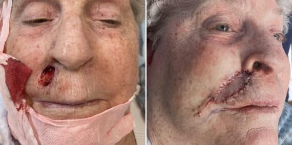 Mohs Reconstruction Before and After Photos in Voorhees Township, NJ, Patient 4200