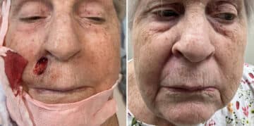 Mohs Reconstruction Before and After Photos in Voorhees Township, NJ, Patient 4200