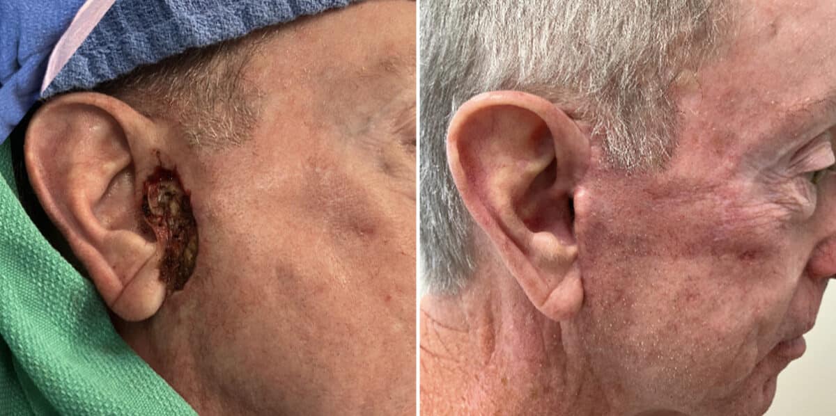 Mohs Reconstruction Before and After Photos in Voorhees Township, NJ, Patient 4201