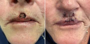 Mohs Reconstruction Before and After Photos in Voorhees Township, NJ, Patient 4224