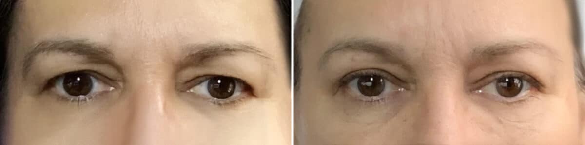 Blepharoplasty Before and After Photos in Philadelphia, PA, Patient 4257