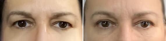 Blepharoplasty Before and After Photos in Philadelphia, PA, Patient 4257