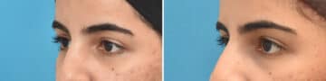 Blepharoplasty Before and After Photos in Philadelphia, PA, Patient 4258