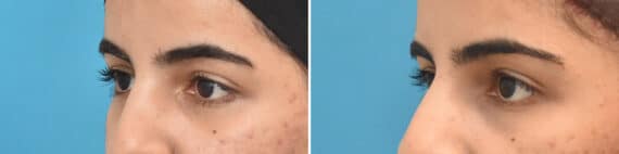 Blepharoplasty Before and After Photos in Philadelphia, PA, Patient 4258