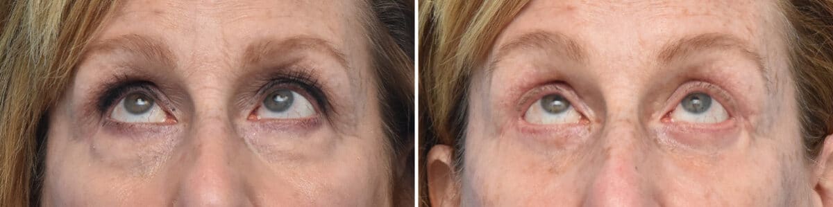 Blepharoplasty Before and After Photos in Philadelphia, PA, Patient 4268