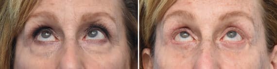 Blepharoplasty Before and After Photos in Philadelphia, PA, Patient 4268