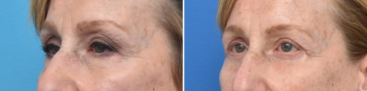 Blepharoplasty Before and After Photos in Philadelphia, PA, Patient 4268