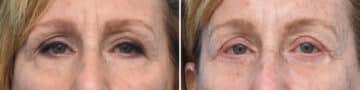 Blepharoplasty Before and After Photos in Philadelphia, PA, Patient 4268