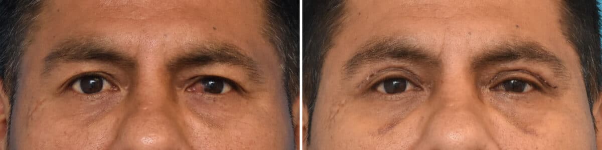 Blepharoplasty Before and After Photos in Philadelphia, PA, Patient 4269