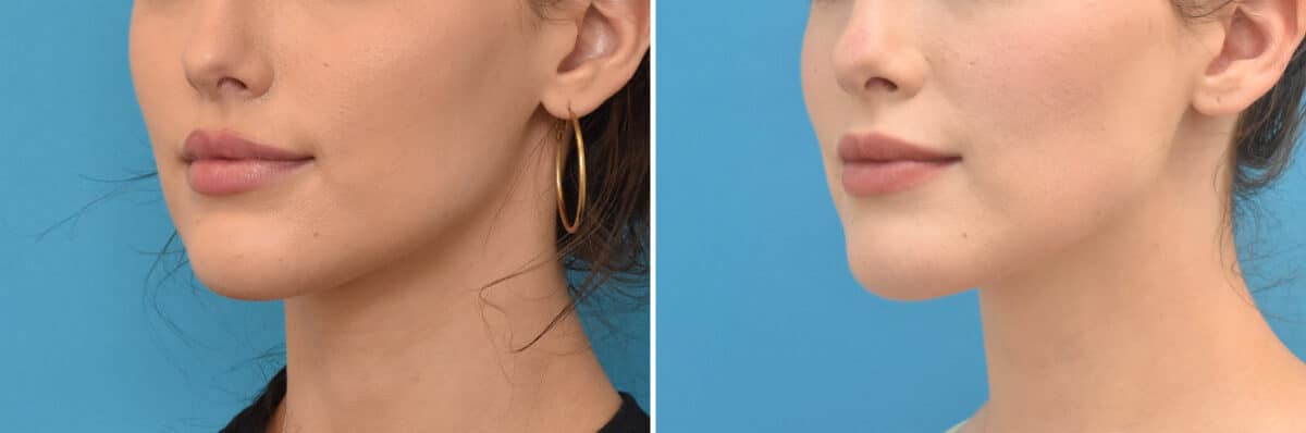 Facial Slimming Before and After Photos in Philadelphia, PA, Patient 4282