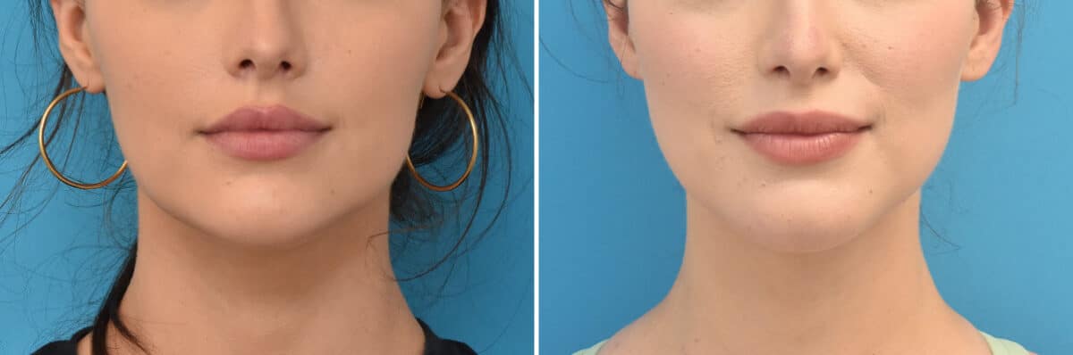 Facial Slimming Before and After Photos in Philadelphia, PA, Patient 4282