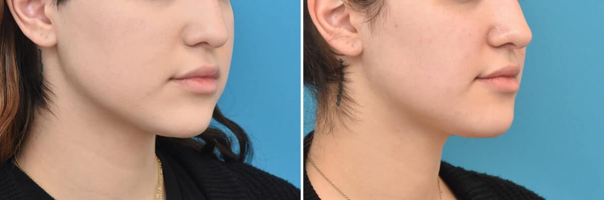 Facial Slimming Before and After Photos in Philadelphia, PA, Patient 4283