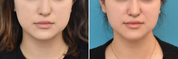 Facial Slimming Before and After Photos in Philadelphia, PA, Patient 4283