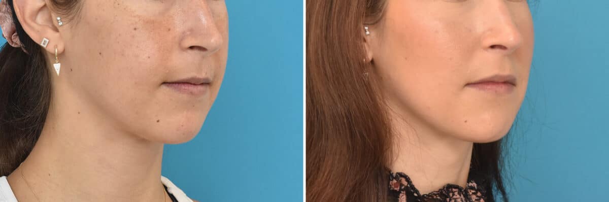 Facial Slimming Before and After Photos in Philadelphia, PA, Patient 4284