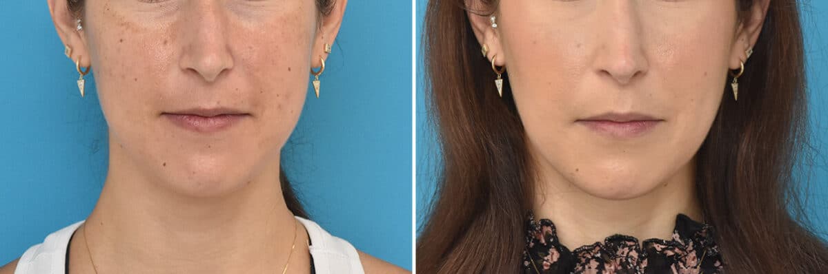 Facial Slimming Before and After Photos in Philadelphia, PA, Patient 4284