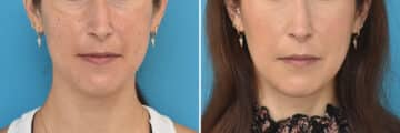 Facial Slimming Before and After Photos in Philadelphia, PA, Patient 4284