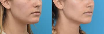 Facial Slimming Before and After Photos in Philadelphia, PA, Patient 4285