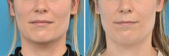 Facial Slimming Before and After Photos in Philadelphia, PA, Patient 4286