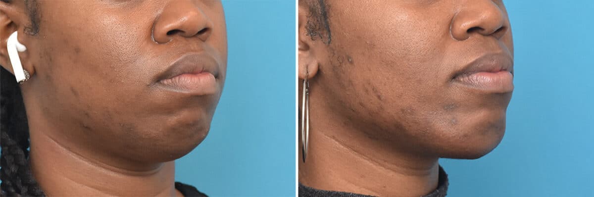 Chin Implants Before and After Photos in , , Patient 4311