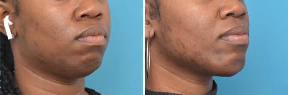 Chin Implants Before and After Photos in Philadelphia, PA, Patient 4311