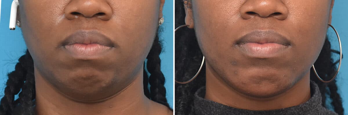 Chin Implants Before and After Photos in , , Patient 4311