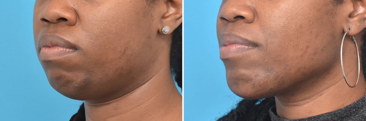 Chin Implants Before and After Photos in , , Patient 4311