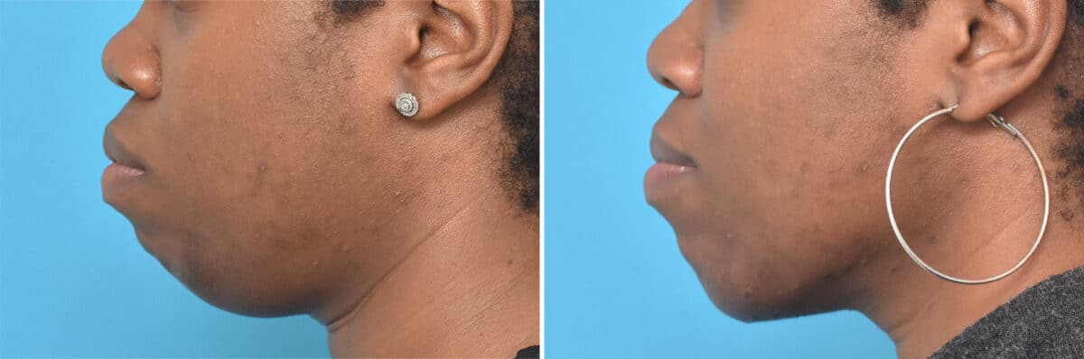 Chin Implants Before and After Photos in , , Patient 4311