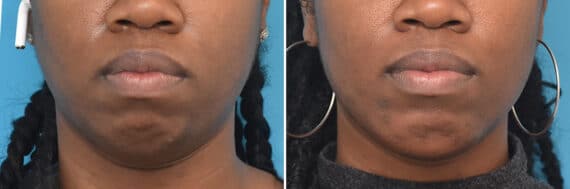 Chin Implants Before and After Photos in Philadelphia, PA, Patient 4311