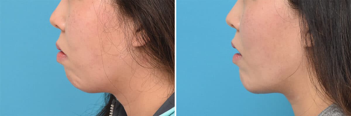 Chin Implants Before and After Photos in Philadelphia, PA, Patient 4312