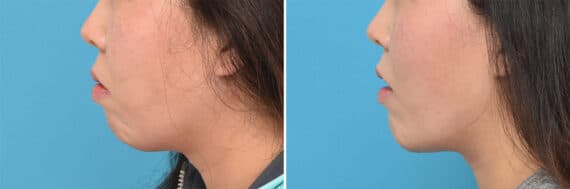 Chin Implants Before and After Photos in Philadelphia, PA, Patient 4312