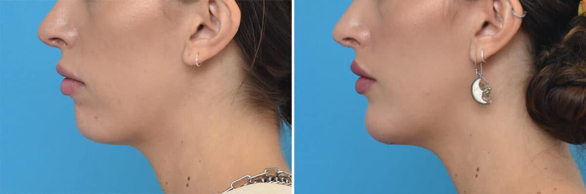 Chin Implants Before and After Photos in Philadelphia, PA, Patient 4313