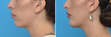 Chin Implants Before and After Photos in Philadelphia, PA, Patient 4313