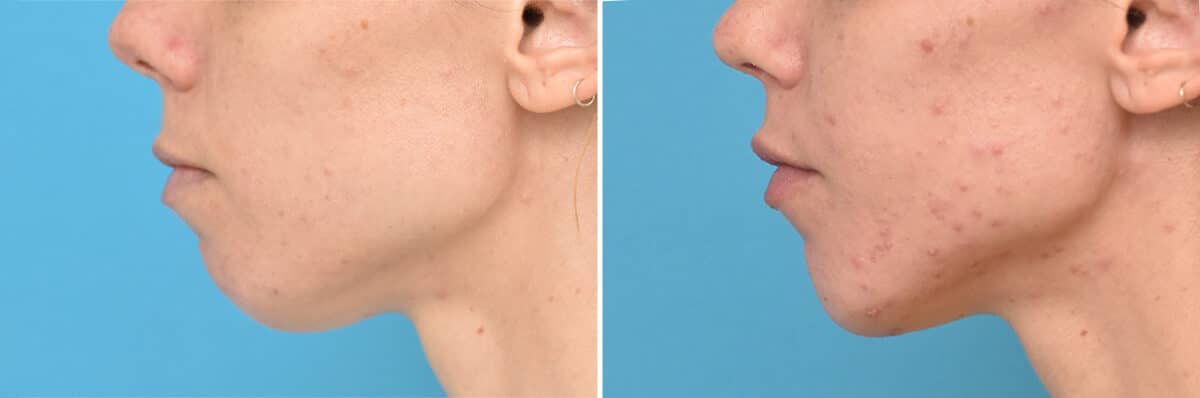 Chin Implants Before and After Photos in Philadelphia, PA, Patient 4314