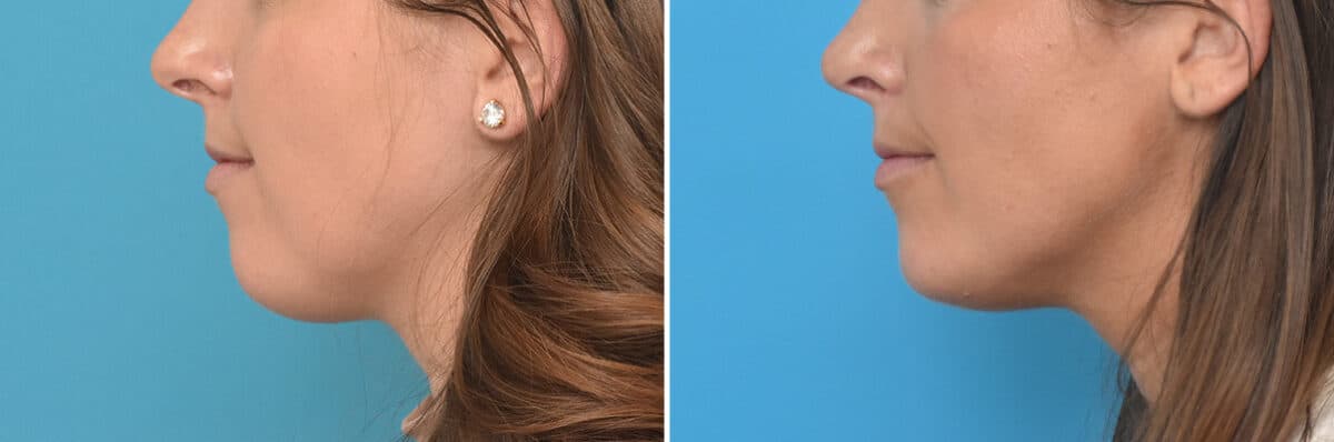 Chin Implants Before and After Photos in Philadelphia, PA, Patient 4315