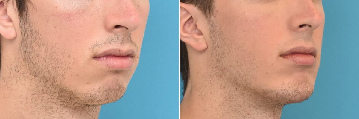 Chin Implants Before and After Photos in Philadelphia, PA, Patient 4316