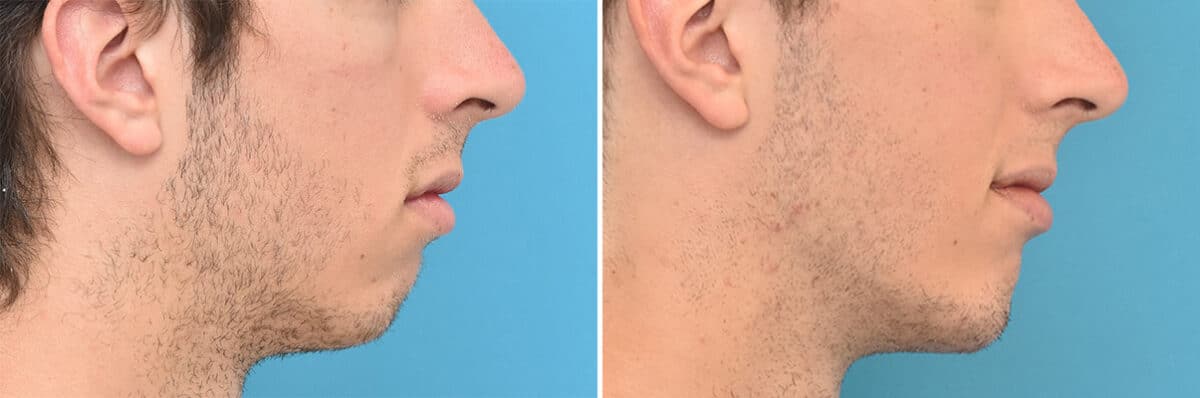 Chin Implants Before and After Photos in Philadelphia, PA, Patient 4316