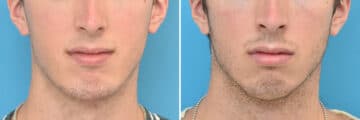 Chin Implants Before and After Photos in Philadelphia, PA, Patient 4316