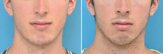 Chin Implants Before and After Photos in Philadelphia, PA, Patient 4316