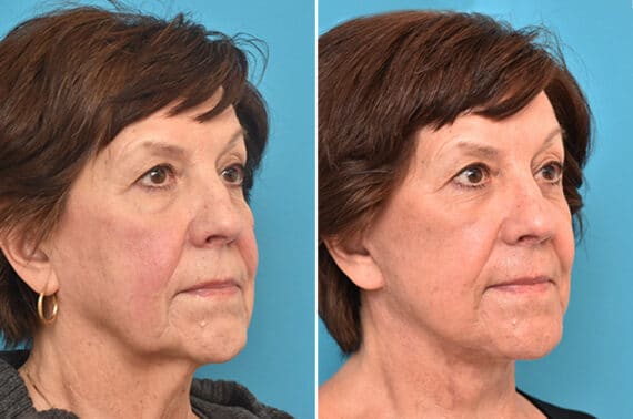 Facelift Before and After Photos in Philadelphia, PA, Patient 4353