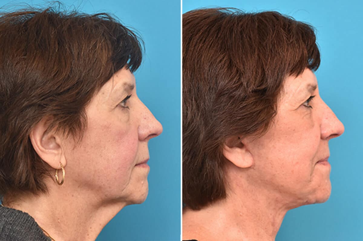 Facelift Before and After Photos in Philadelphia, PA, Patient 4353