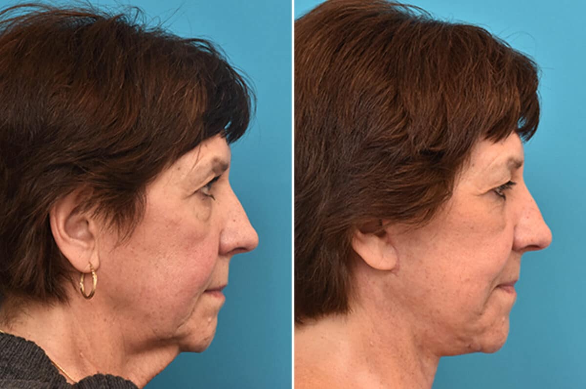 Facelift Before and After Photos in Philadelphia, PA, Patient 4353