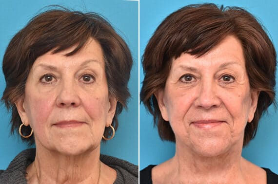 Facelift Before and After Photos in Philadelphia, PA, Patient 4353