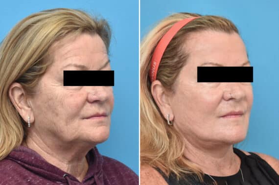 Facelift Before and After Photos in Philadelphia, PA, Patient 4354