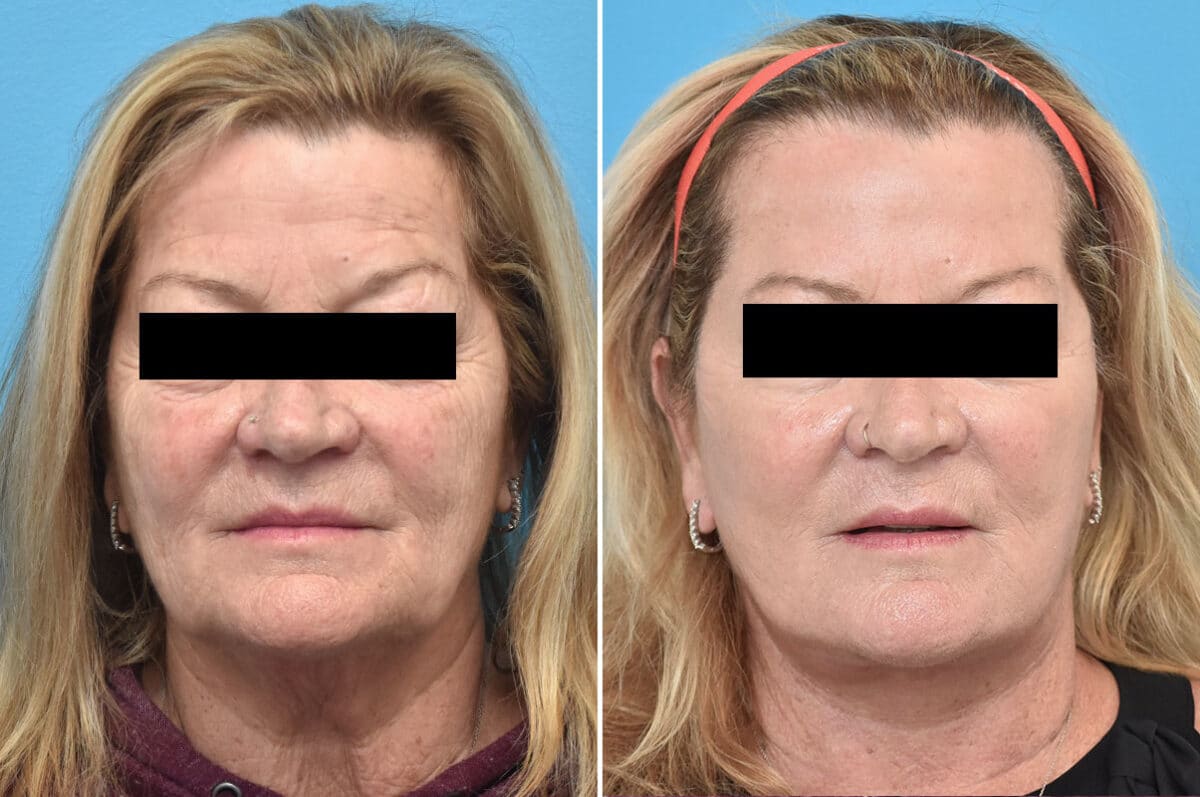 Facelift Before and After Photos in Philadelphia, PA, Patient 4354