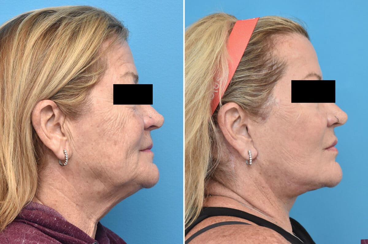 Facelift Before and After Photos in Philadelphia, PA, Patient 4354