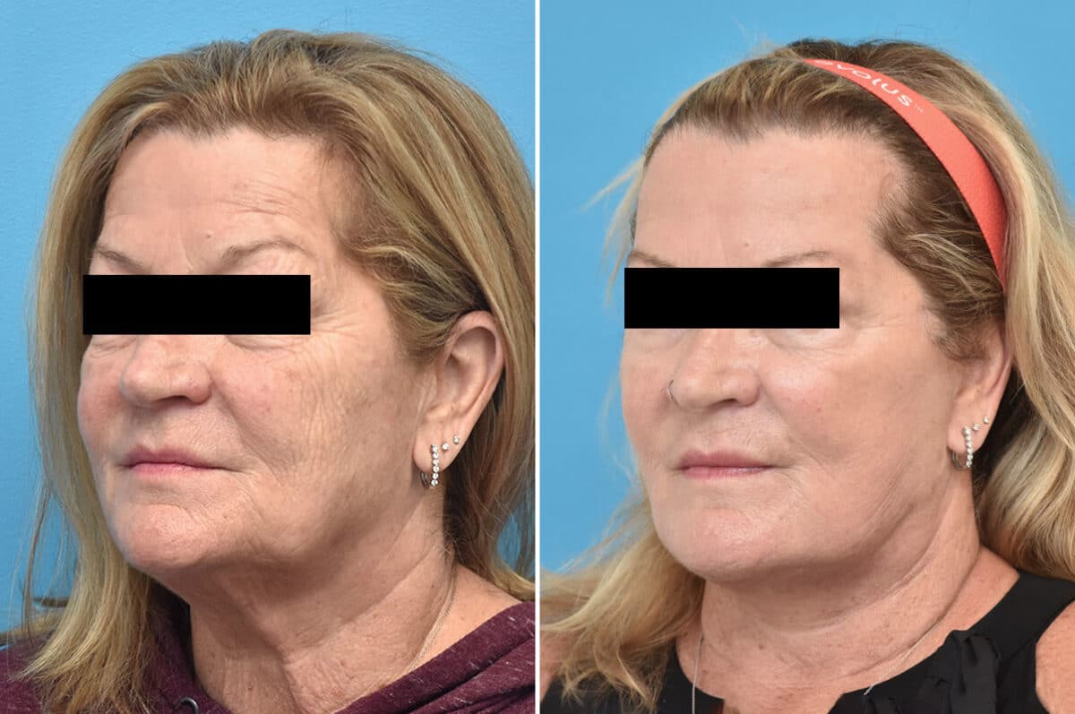 Facelift Before and After Photos in Philadelphia, PA, Patient 4354